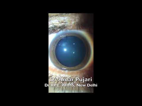 Cornea And Anterior Segment Photography Technique By Smartphones