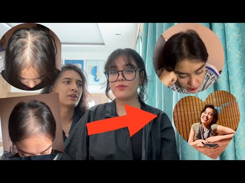 My Hair Transplant Journey 