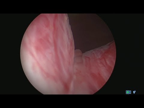 Raten von Prostatitis Prostata Schmerzen in der Prostata-Analyse