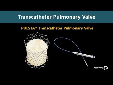 Pulsta™ Transcatheter Pulmonary Valve