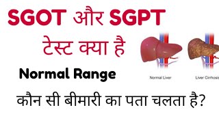 Watch video SGOT Blood Test | SGPT Blood Test | ALT | AST | SGOT & SGPT Test Normal Range Now SGOT Blood Test | SGPT Blood Test | ALT | AST | SGOT & SGPT Test Normal Range