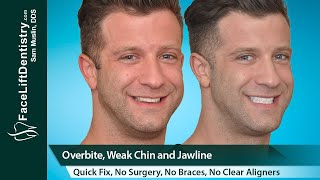 Overbite Jaw Surgery Alternative, Only 8-Days. No Drilling, No Braces, No Surgery