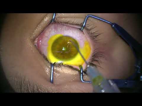 Refacerea vederii după transplantul corneei