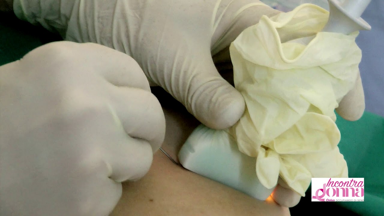 Ago, Biopsia, Citologia Fibroadenoma