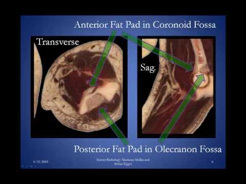 Elbow Joint Effusion Version 1 0