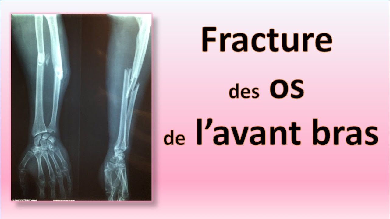 Fracture des Os de l'avant bras 💪🦴 - Arabic