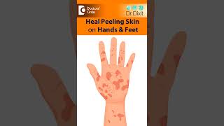 SKIN PEELING from Hand & Feet-Is it Eczema, Psoriasis,Fungus?-Dr.Rasya Dixit|Doctors