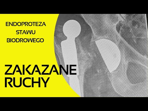 #1 Endoproteza stawu biodrowego - trzy zakazane ruchy