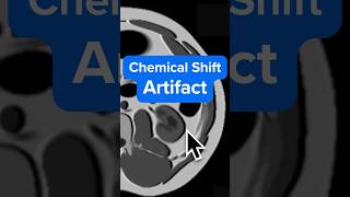 MRI Chemical Shift Artifact in 71 seconds u2013 Why It Happens and How to Fix It
