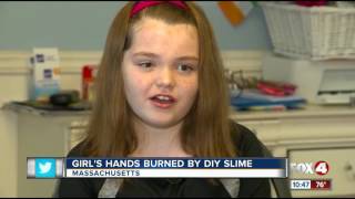 Third degree burns from homemade slime