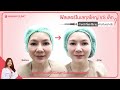 หมอฮัลขอเล่า ทำไมฟิลเลอร์ถึงมีโมเลกุลเล็ก และโมเลกุลใหญ่