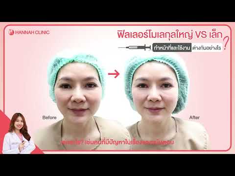 หมอฮัลขอเล่า ทำไมฟิลเลอร์ถึงมีโมเลกุลเล็ก และโมเลกุลใหญ่