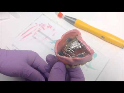 Unterfütterung einer Totalprothese / stabile Prothese/ Saugeffekt - Zahnarzt Burgdorf Hannover