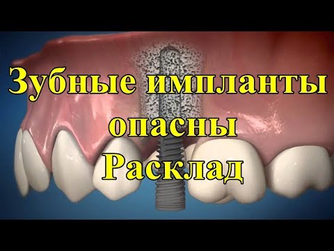 Зубные импланты опасны. Расклад.
