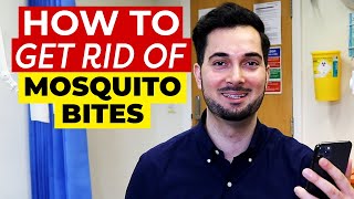 Mosquito Bites | How To Get Rid Of Mosquito Bites