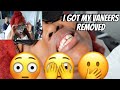I GOT MY VANEERS REMOVED