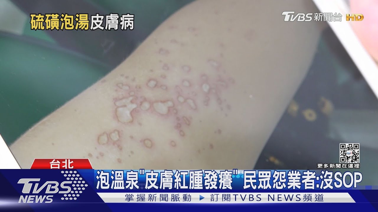 泡溫泉「皮膚紅腫發癢」 民眾怨業者:沒SOP