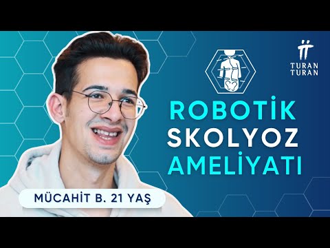 I Had Scoliosis Surgery! Full Before & After Journey (Robotic Surgery)