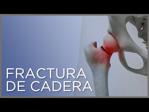 Fractura de cadera: causas, síntomas y tratamiento