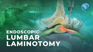 What is Endoscopic Lumbar Laminotomy?  Laminectomy