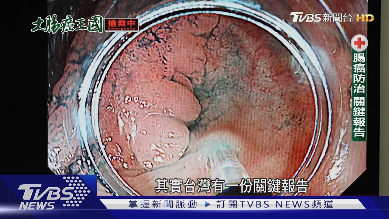 大腸癌蟬聯癌王15年! 「兩城市做這事」罹腸癌機率低22%