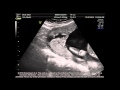 Sonography of placenta percreta (fourth pregnancy) – Video S1 [ID 100321]