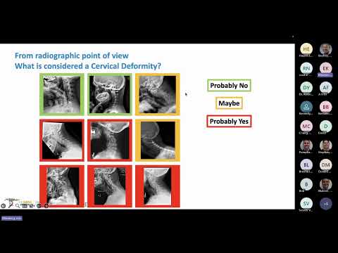 Cervical Deformity: Where Are We Now? Presented by Eric Klineberg, MD