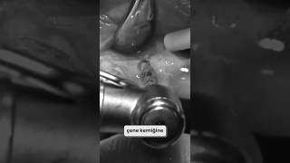 İMPLANT TEDAVİSİ NASIL YAPILMALI ?