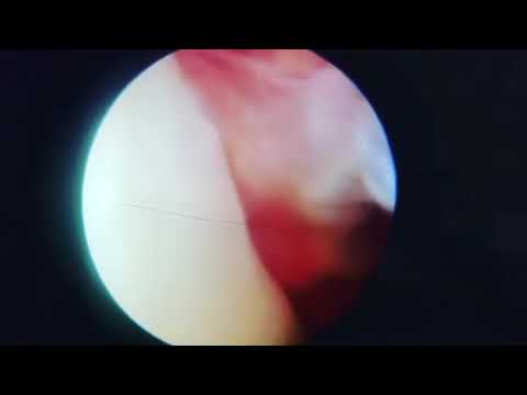 Whats causing multiple or recurrent dislocations of my shoulder? Dr Manit Arora