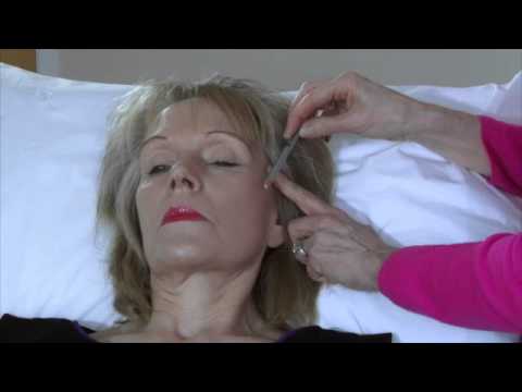 Sculptra clinic of excellence & the differences between fillers