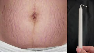 Sadece bir mumla ciltte çatlak izlerine veda edin.