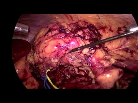 Laparoscopy-assisted Robotic Partial Nephrectomy (LARPN)