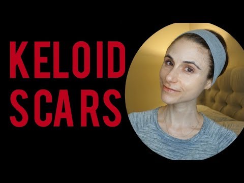 Treatments for Keloid Scars: Q&A with a dermatologist|Dr Dray