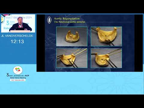 IA et dilatation de l’aorte ascendante anatomie fonctionnelle et évaluation quantitative