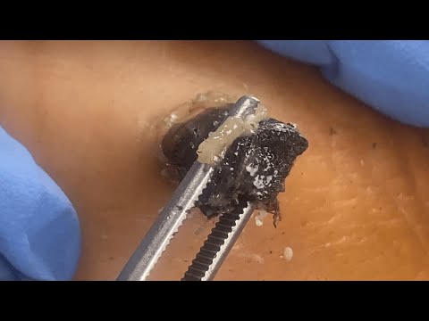 DR LEE’S TLC dr. pimple popper blackheads satisfying cyst removal ASMR😪しっかり深く掃除する耳かき 2210M13196