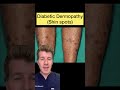 12 Skin Conditions Linked With Diabetes Shorts Diabetes Dermatology Doctor Health