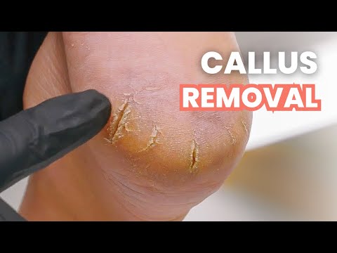 MONSTER Heel Crack Removal | Satisfying Pedicure Tutorial