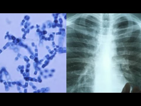 Hidden fungus causing more Valley Fever in southern Utah