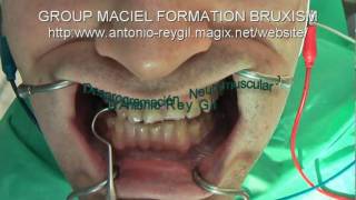 Dentistas Valladolid, Dr.A.Rey Gil ,Bruxismo,Bruxism  -3-Miocéntrica,Desprogramación