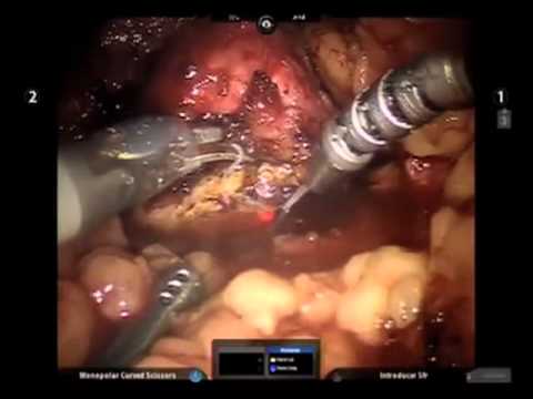 Robotic Laser Partial Nephrectomy