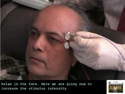 SFEMG - Stimulation Frontalis Surface  (Erik Stalberg)