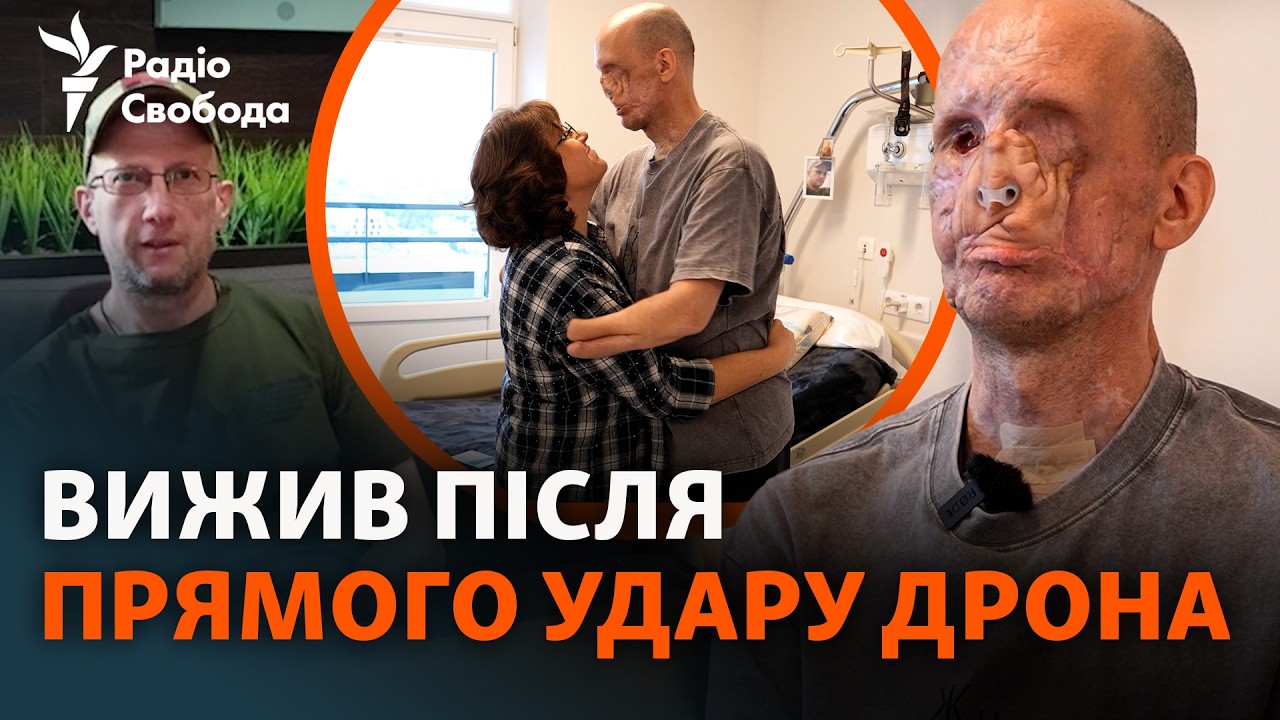 На обличчі не збереглися кістки: боєць після важкого поранення наново вчить?