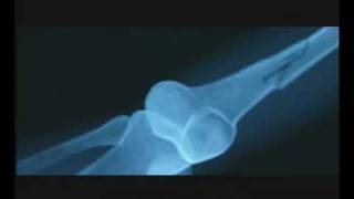 Fragile - Trailer Italiano (2005)