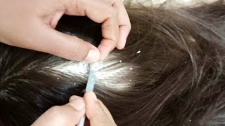 ASMR ✨ The Most Satisfying Scalp Treatment Experience, SCRATCHING &amp; Deep Sleep 😴#asmr #sleep #relax