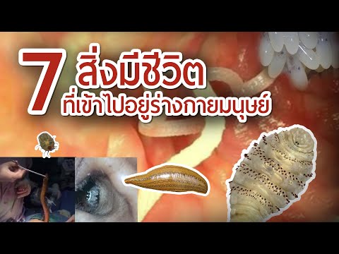 อาการเริ่มต้นของโรคสะเก็ดเงินรูปภาพ การวินิจฉัยแยกโรคของ seborrhea และโรคสะเก็ดเงิน