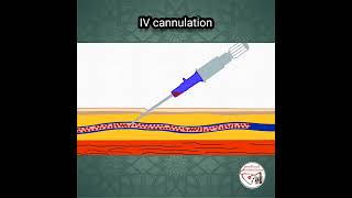 Download lagu 💉 INTRAVENOUS (IV) CANNULATION ANIMATION mp3