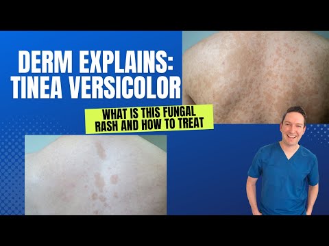 Dermatologist explains Tinea Versicolor: What is this rash and how can you treat it? #tinea #rash