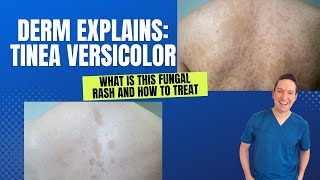 Dermatologist explains Tinea Versicolor: What is this rash and how can you treat it? #tinea #rash