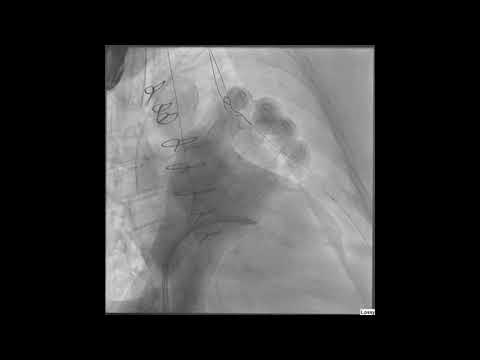 Ruiz First Reported Percutaneous Trans Carotid Transcatheter Aortic Valve _Structural_FINALS