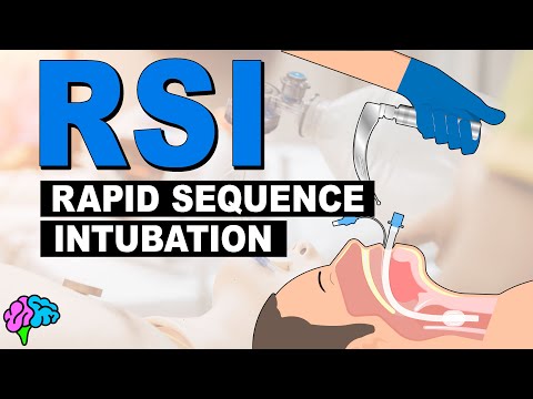 What is Rapid Sequence Intubation (RSI)?